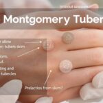 tubercules de montgomery blanc